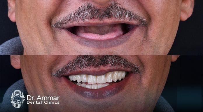 تكلفة زراعة عظم الفك
