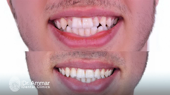 تقويم الأسنان المتحرك للكبار
